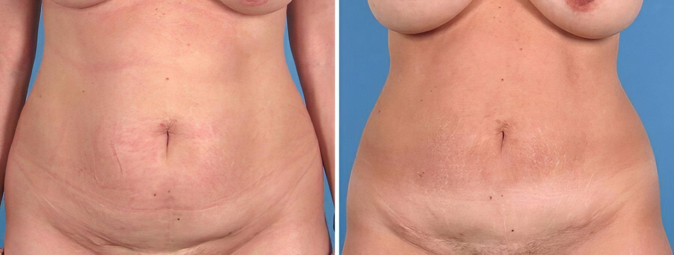 Tummy Tuck Before & After Case 18787
