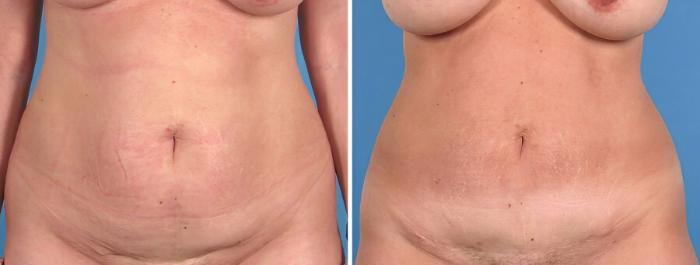 Tummy Tuck Before & After Case 18787