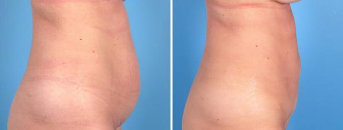 Tummy Tuck Before & After Case 18787