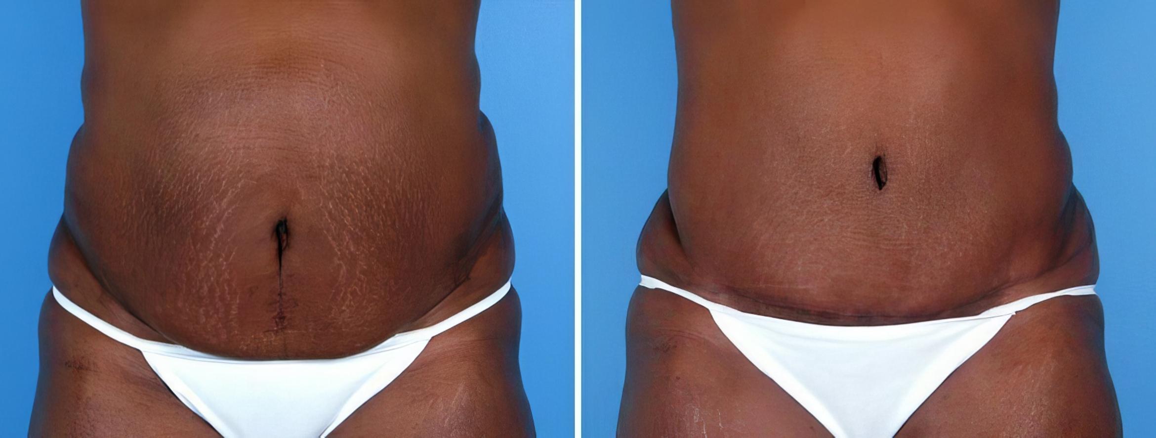 Tummy Tuck Before & After Case 19272