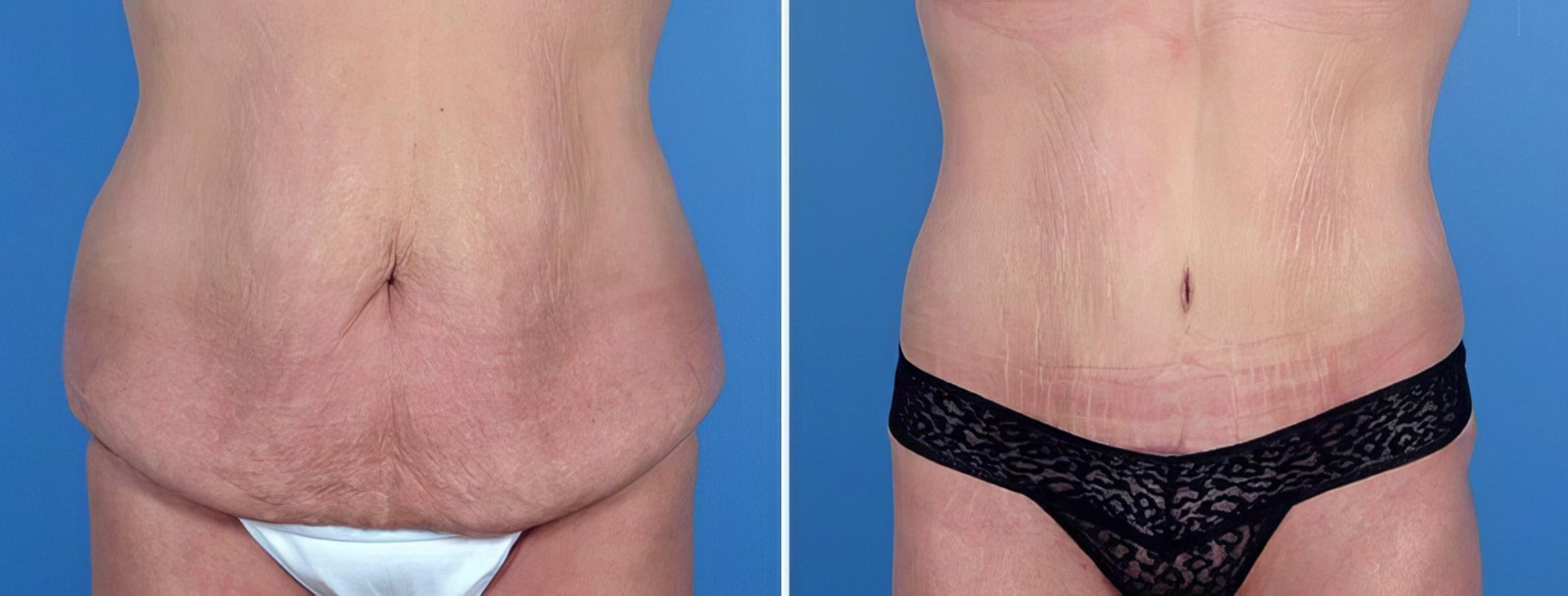 Tummy Tuck Before & After Case 25008