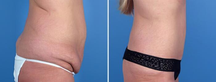 Tummy Tuck Before & After Case 25008
