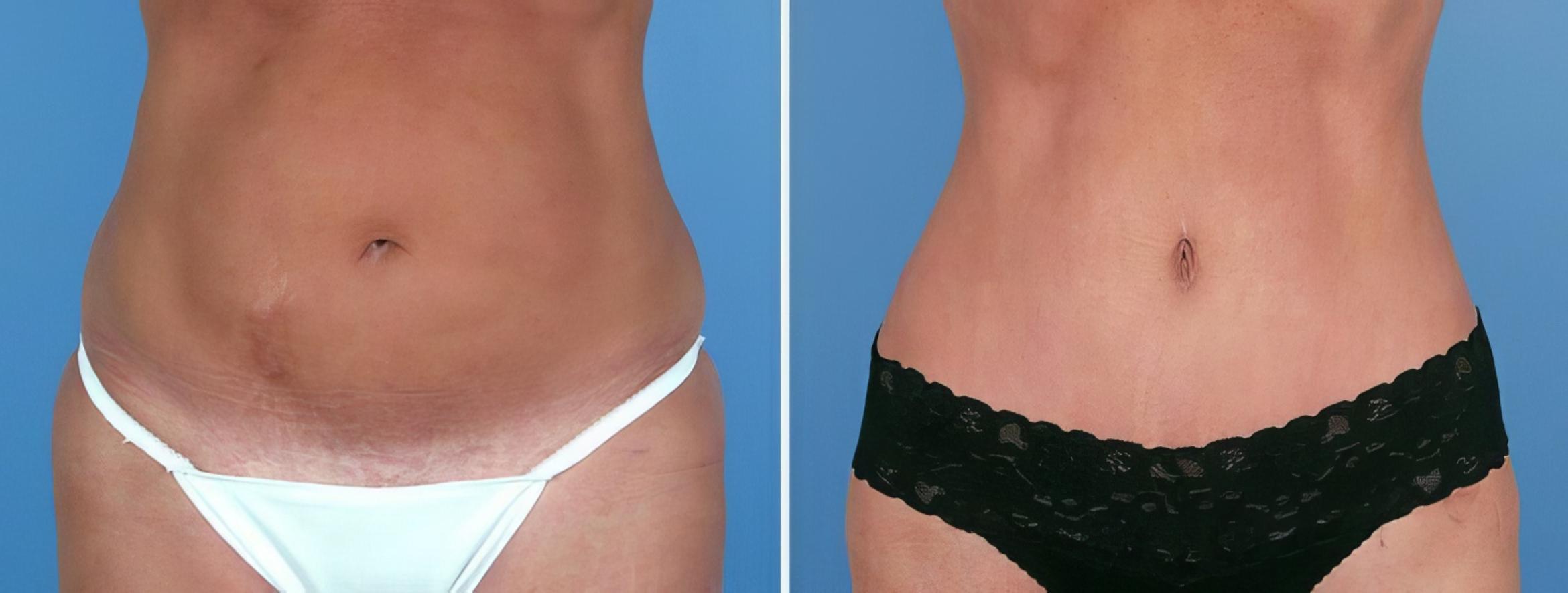 Tummy Tuck Before & After Case 25011