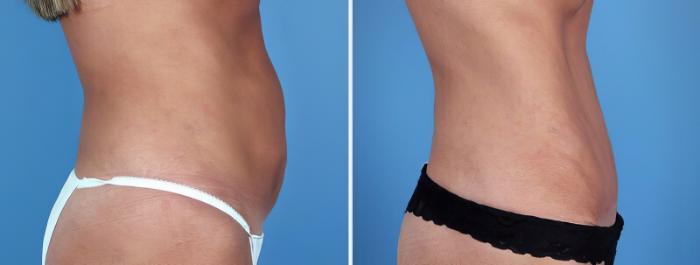 Tummy Tuck Before & After Case 25011