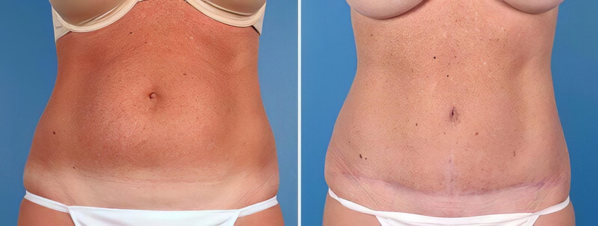 Tummy Tuck Before & After Case 25014
