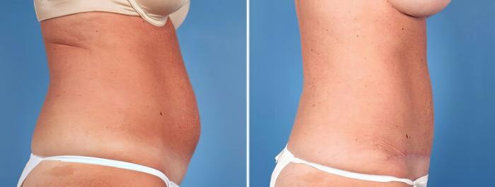 Tummy Tuck Before & After Case 25014