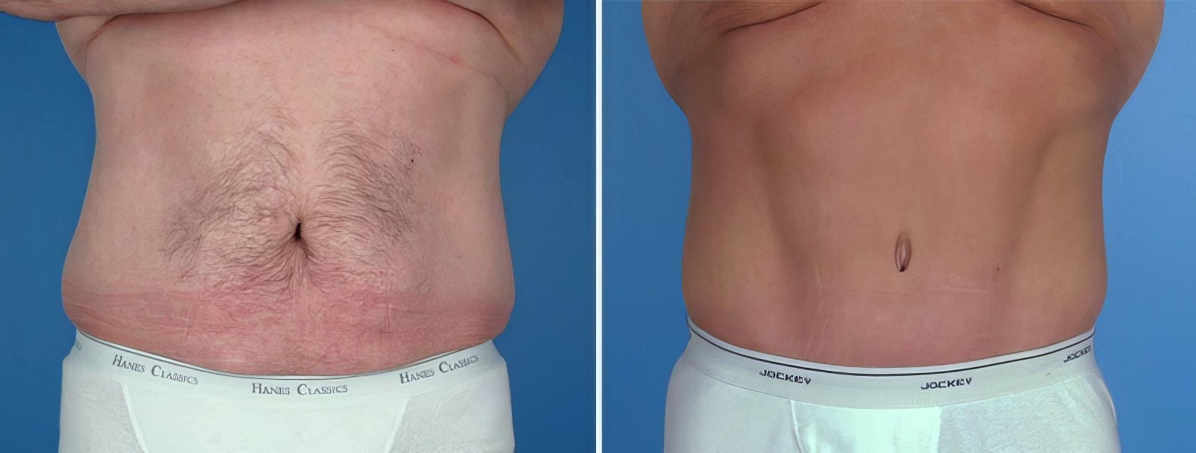 Tummy Tuck Before & After Case 25017