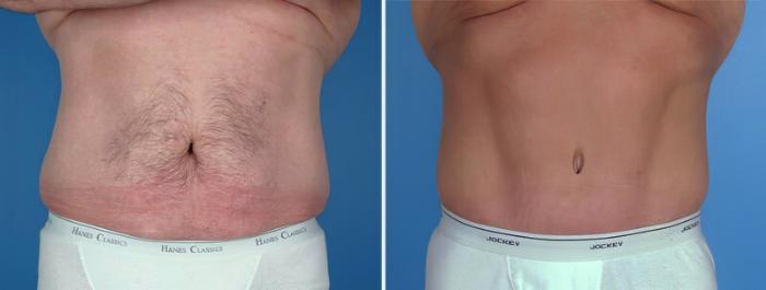 Tummy Tuck Before & After Case 25017