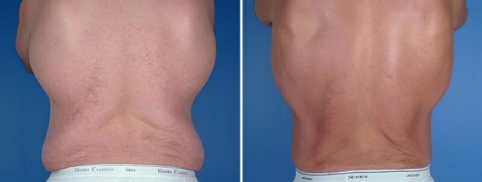 Tummy Tuck Before & After Case 25017