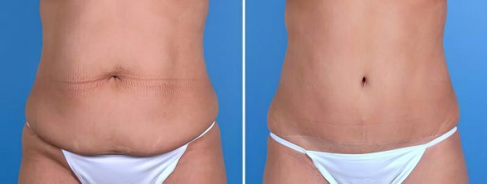 Tummy Tuck Before & After Case 25023