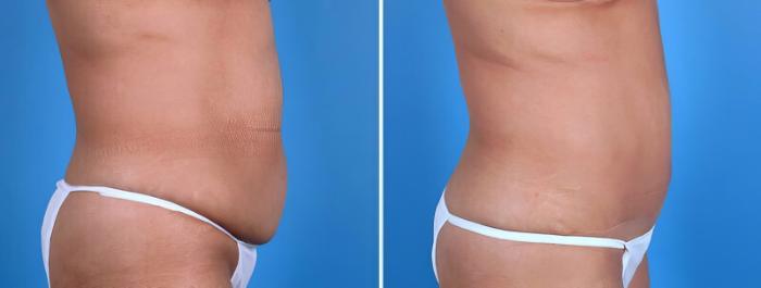Tummy Tuck Before & After Case 25023