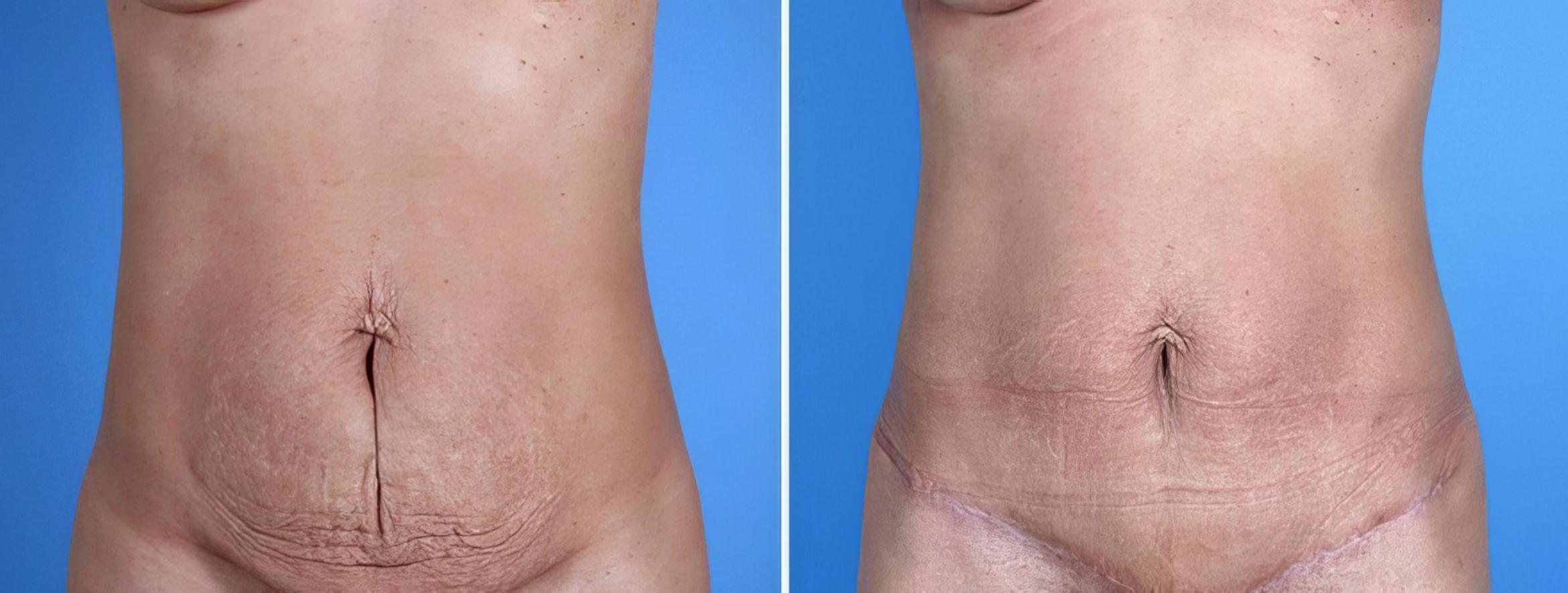 Tummy Tuck Before & After Case 25026
