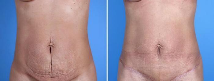Tummy Tuck Before & After Case 25026