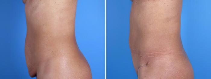 Tummy Tuck Before & After Case 25026