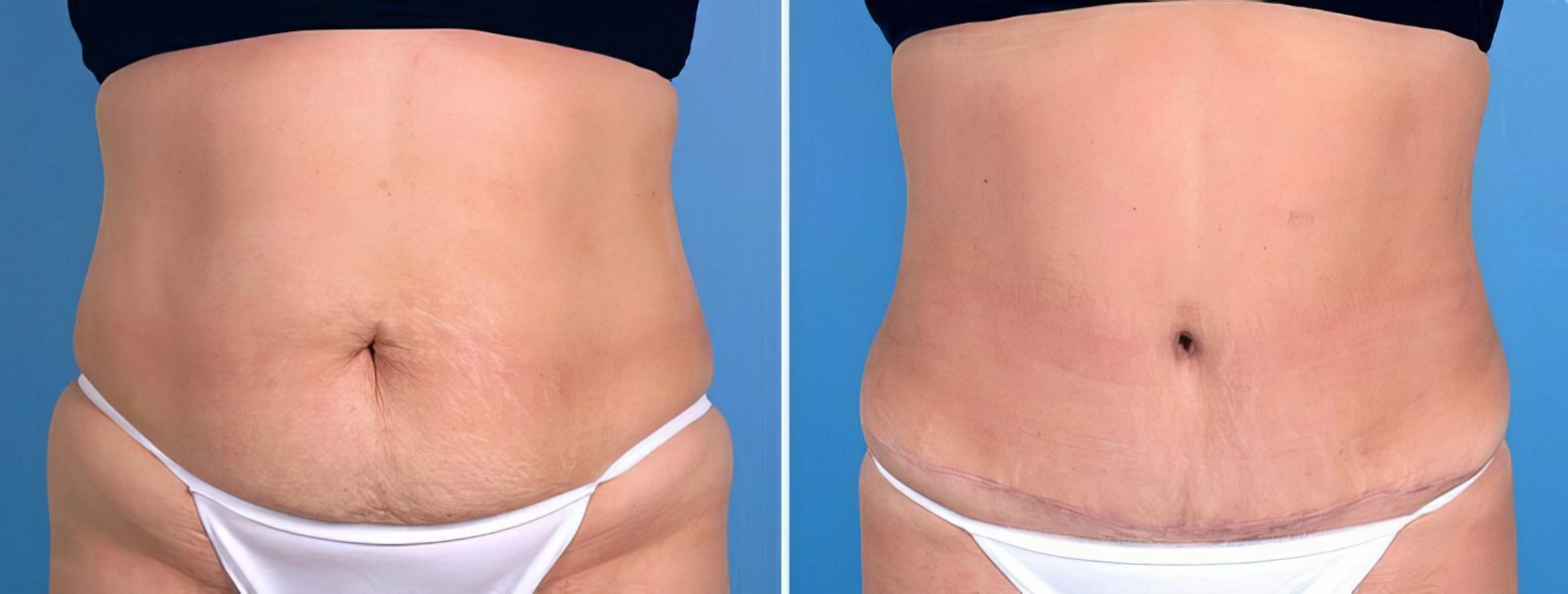 Tummy Tuck Before & After Case 25507