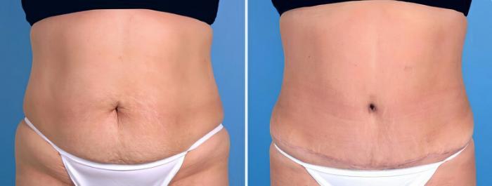 Tummy Tuck Before & After Case 25507