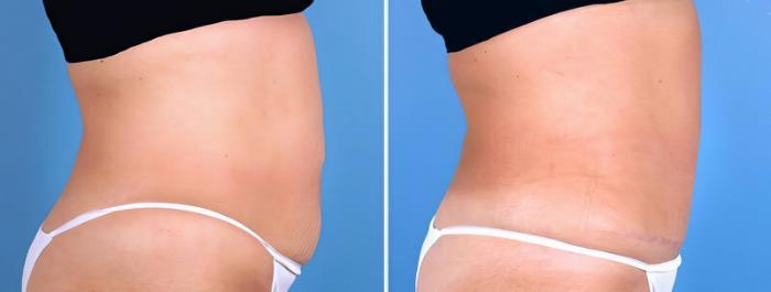 Tummy Tuck Before & After Case 25507