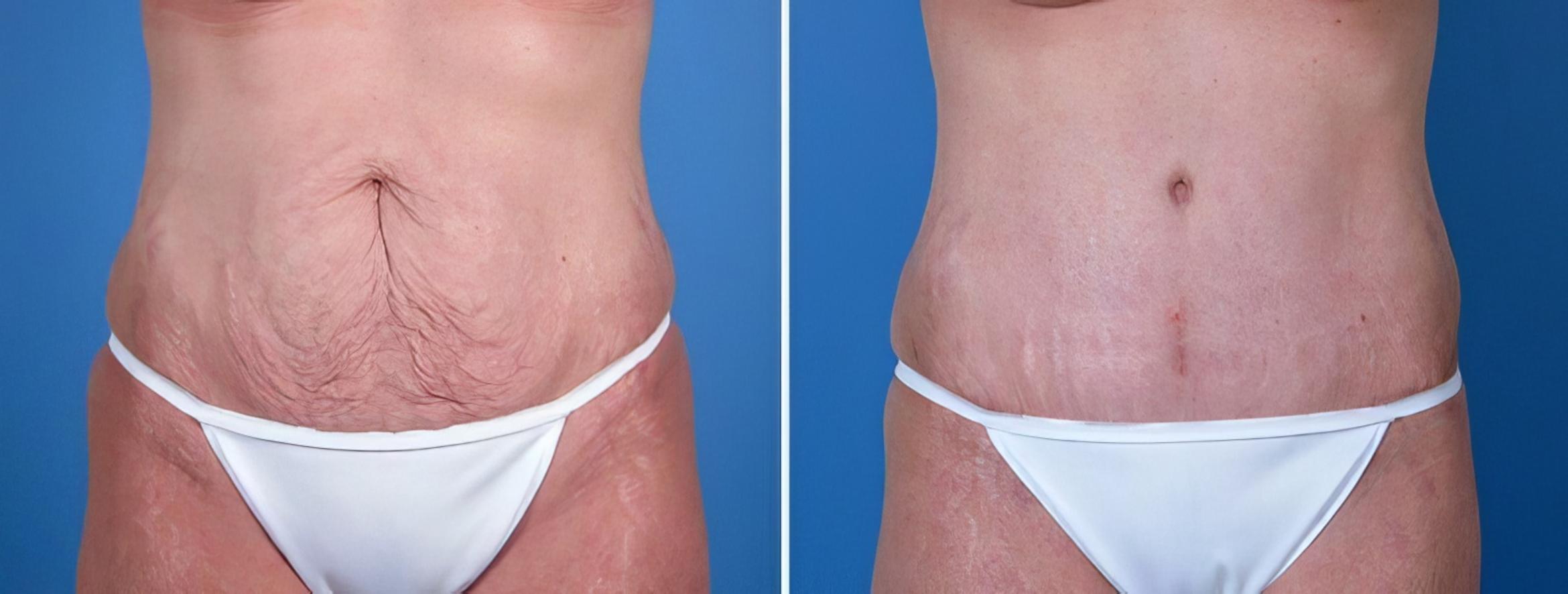 Tummy Tuck Before & After Case 25583