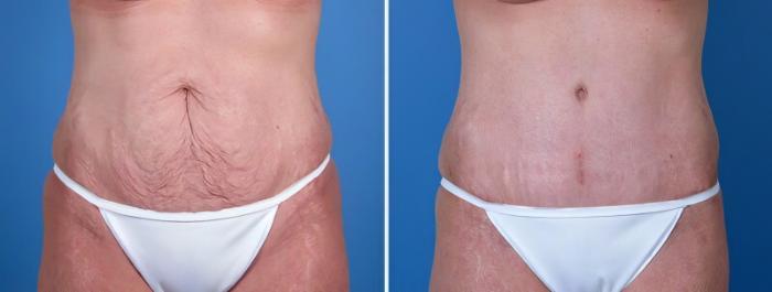 Tummy Tuck Before & After Case 25583