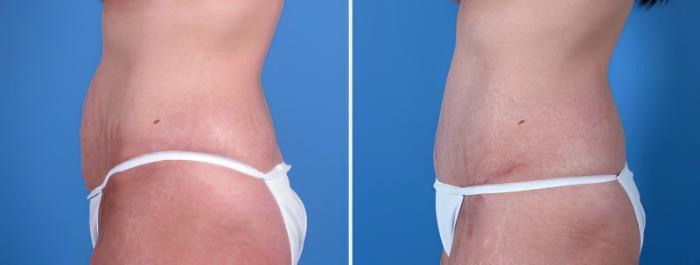 Tummy Tuck Before & After Case 25583