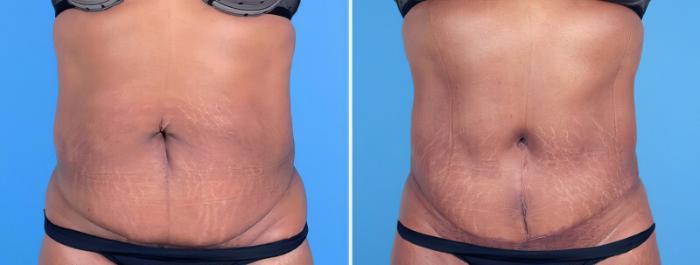 Tummy Tuck Before & After Case 25662