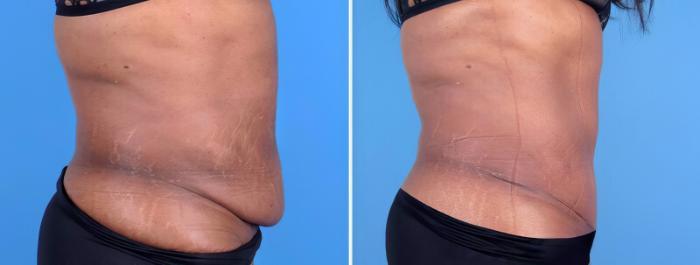 Tummy Tuck Before & After Case 25662