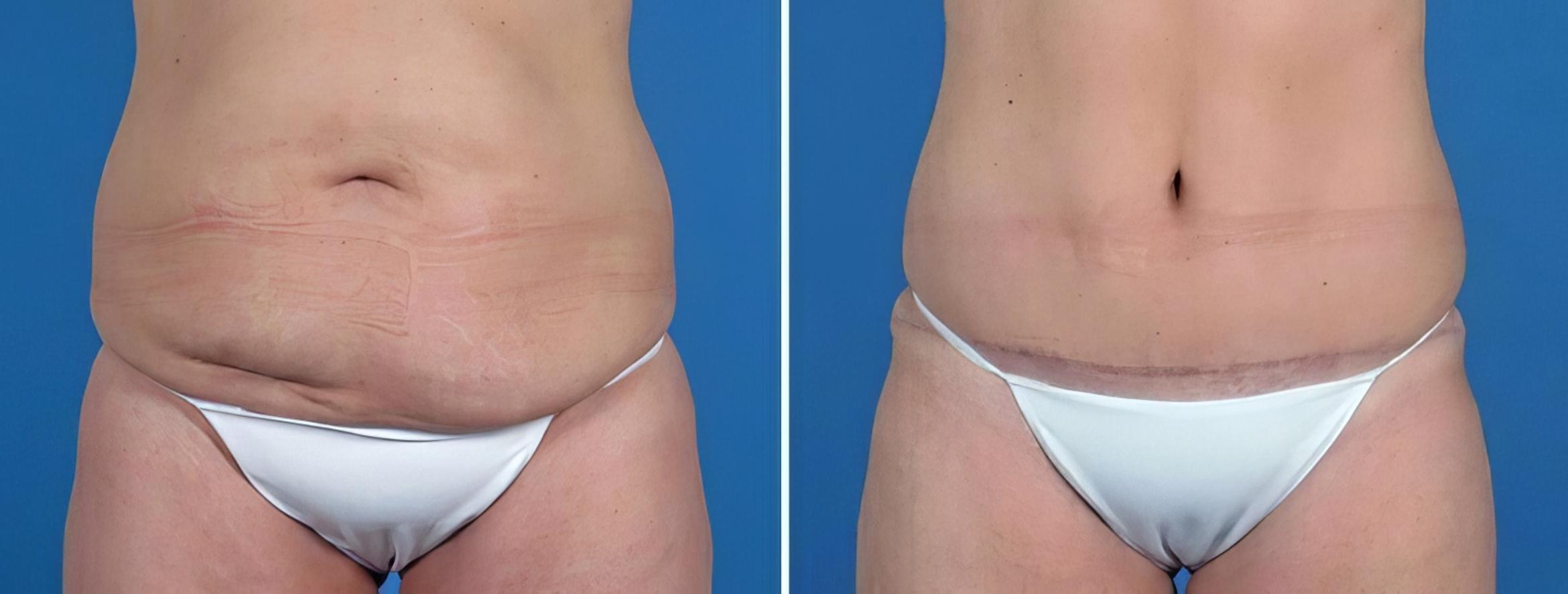 Tummy Tuck Before & After Case 25804