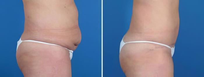 Tummy Tuck Before & After Case 25804