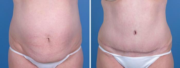 Tummy Tuck Before & After Case 25807