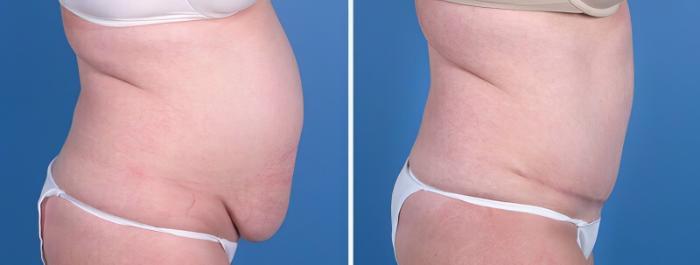 Tummy Tuck Before & After Case 25807