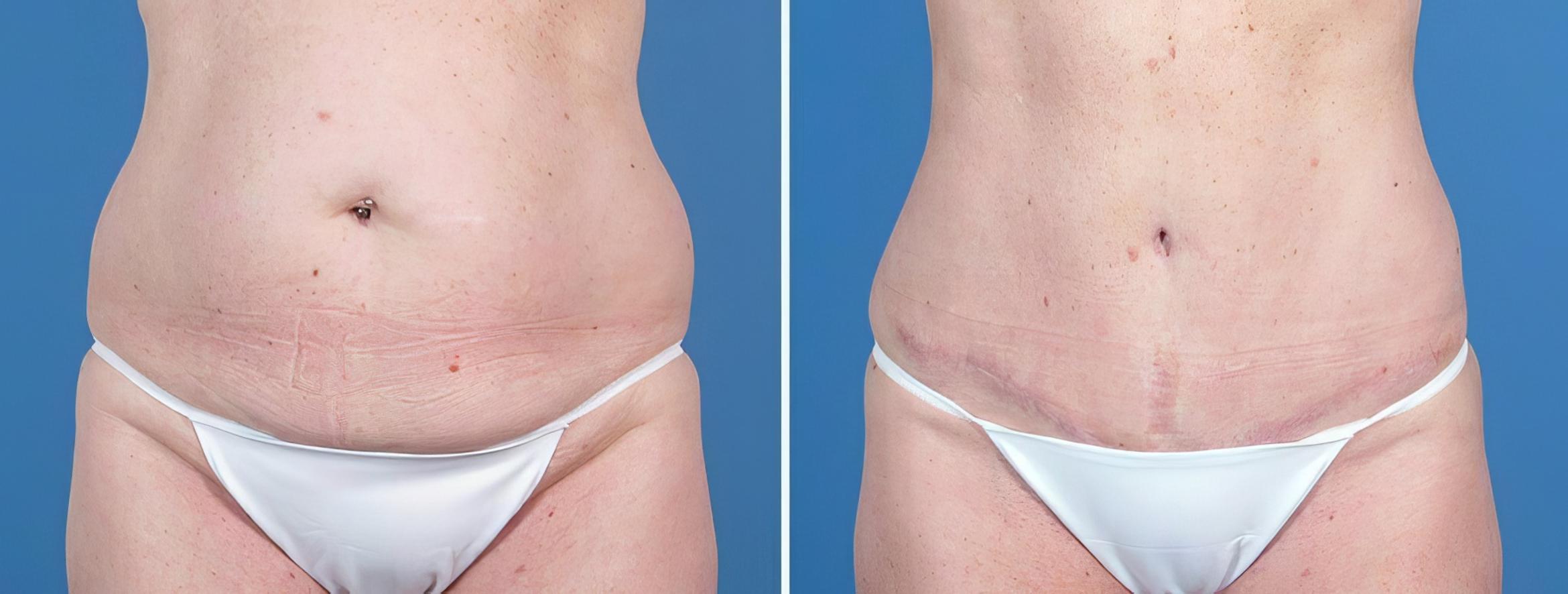 Tummy Tuck Before & After Case 26028