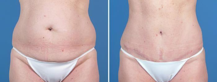 Tummy Tuck Before & After Case 26028