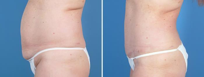 Tummy Tuck Before & After Case 26028