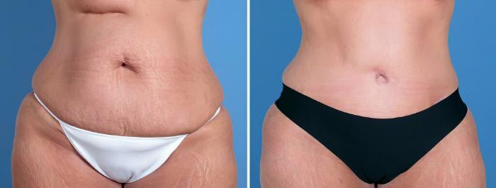 Tummy Tuck Before & After Case 26215