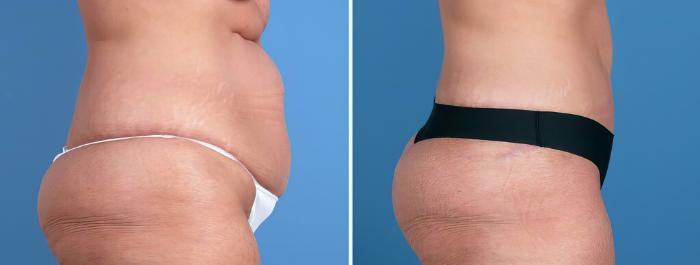 Tummy Tuck Before & After Case 26215