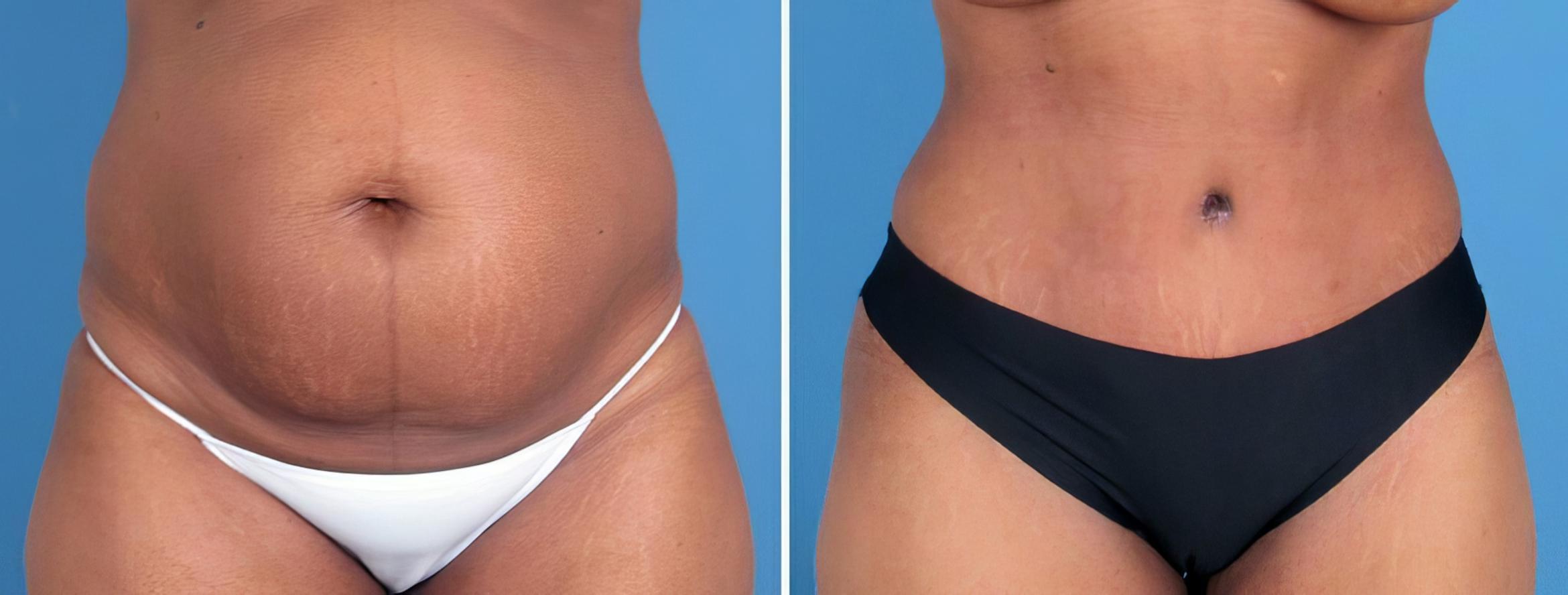 Tummy Tuck Before & After Case 26218