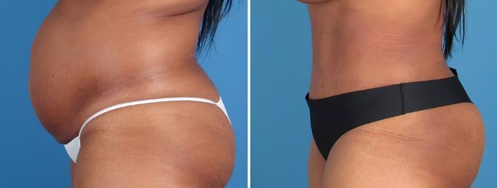 Tummy Tuck Before & After Case 26218