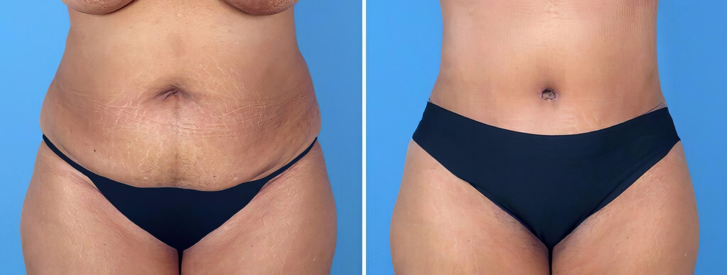Tummy Tuck Before & After Case 26493