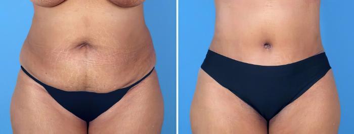 Tummy Tuck Before & After Case 26493