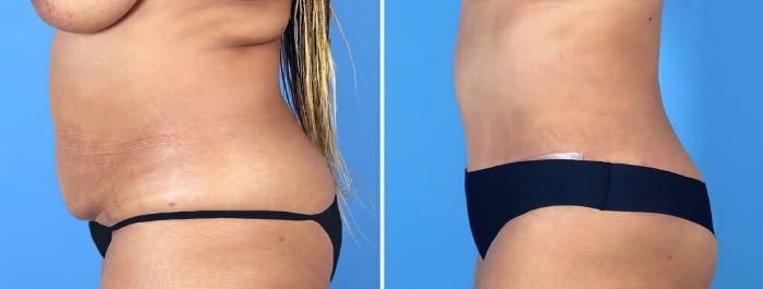 Tummy Tuck Before & After Case 26493