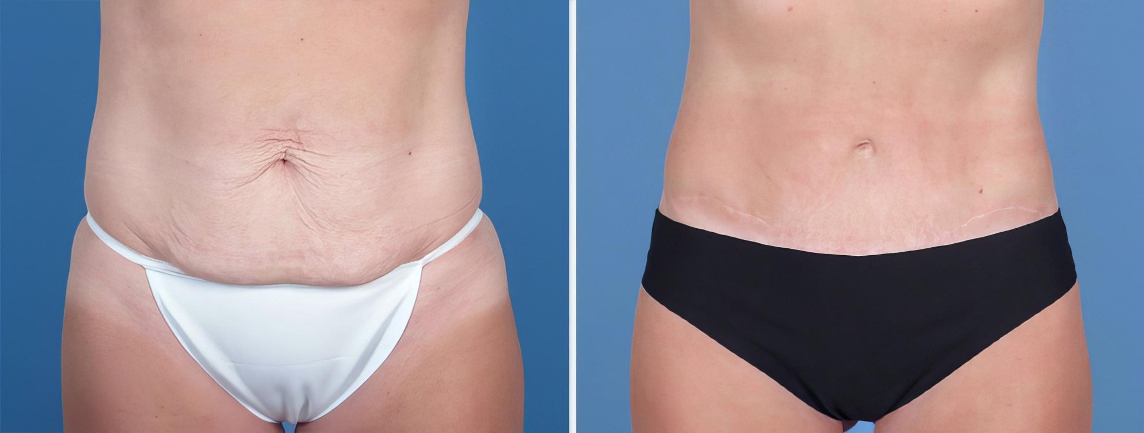 Tummy Tuck Before & After Case 26794