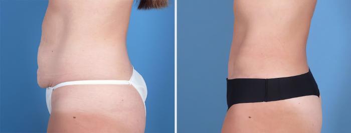 Tummy Tuck Before & After Case 26794