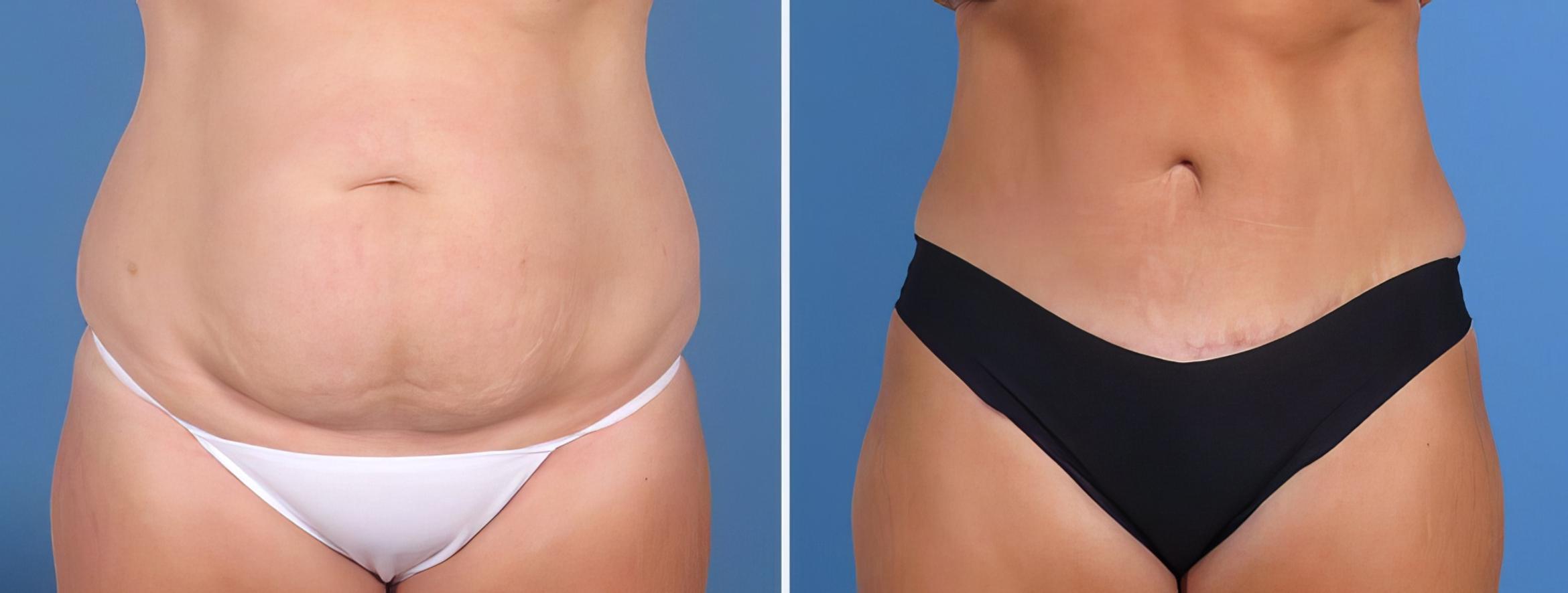 Tummy Tuck Before & After Case 26847