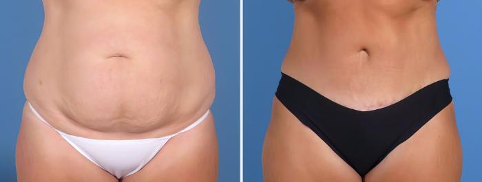 Tummy Tuck Before & After Case 26847