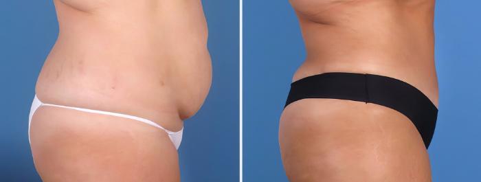 Tummy Tuck Before & After Case 26847
