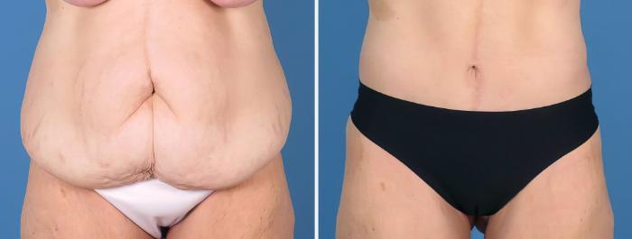 Tummy Tuck Before & After Case 27016