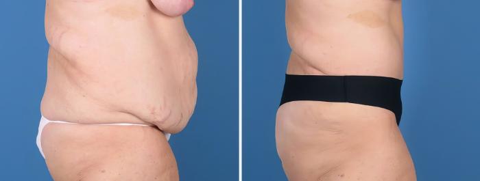 Tummy Tuck Before & After Case 27016