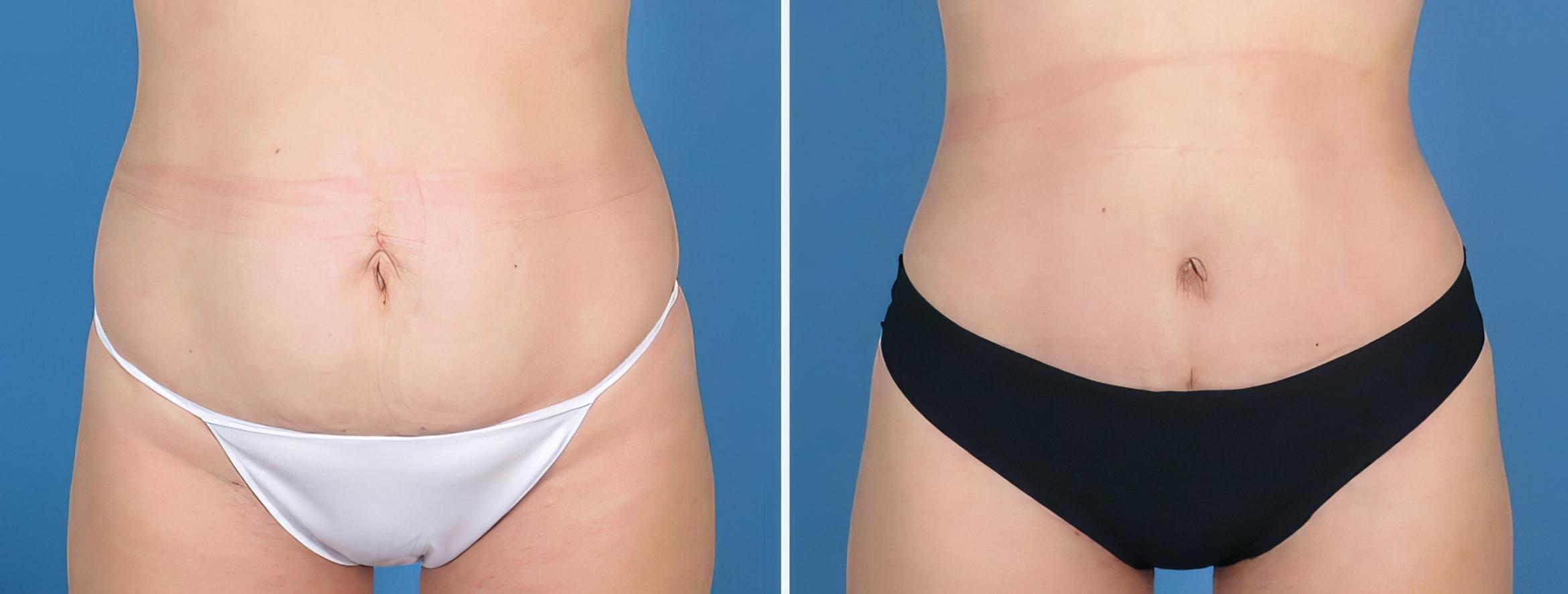 Tummy Tuck Before & After Case 27019