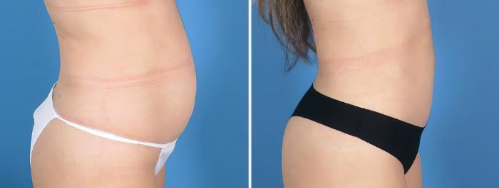 Tummy Tuck Before & After Case 27019