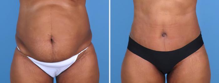 Tummy Tuck Before & After Case 27022